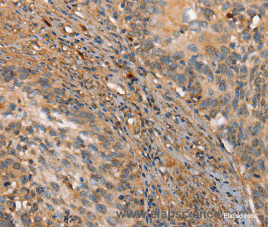 Immunohistochemistry of paraffin-embedded Human cervical cancer tissue using HK3 Polyclonal Antibody at dilution 1:40
