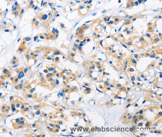 Immunohistochemistry of paraffin-embedded Human thyroid cancer tissue using HK1 Polyclonal Antibody at dilution 1:50