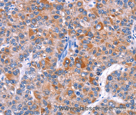 Immunohistochemistry of paraffin-embedded Human liver cancer tissue using ELP2 Polyclonal Antibody at dilution 1:40