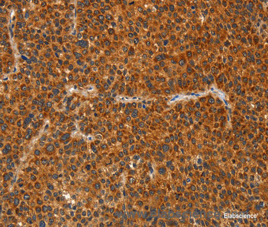 Immunohistochemistry of paraffin-embedded Human liver cancer tissue using IKZF3 Polyclonal Antibody at dilution 1:60
