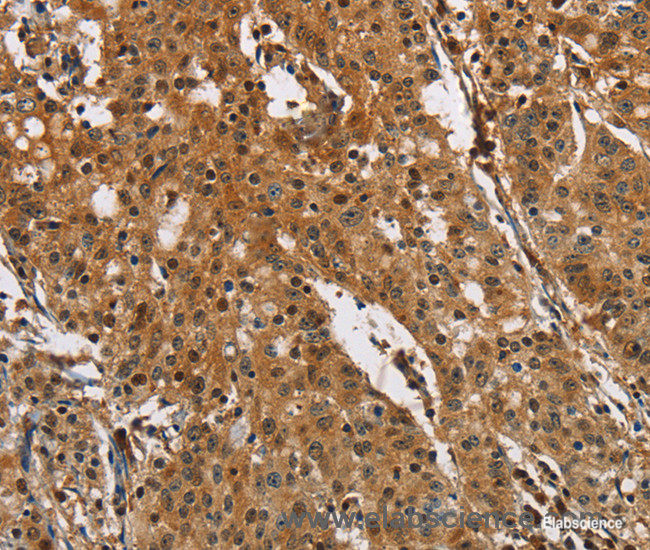 Immunohistochemistry of paraffin-embedded Human gasrtic cancer tissue using PTK6 Polyclonal Antibody at dilution 1:40