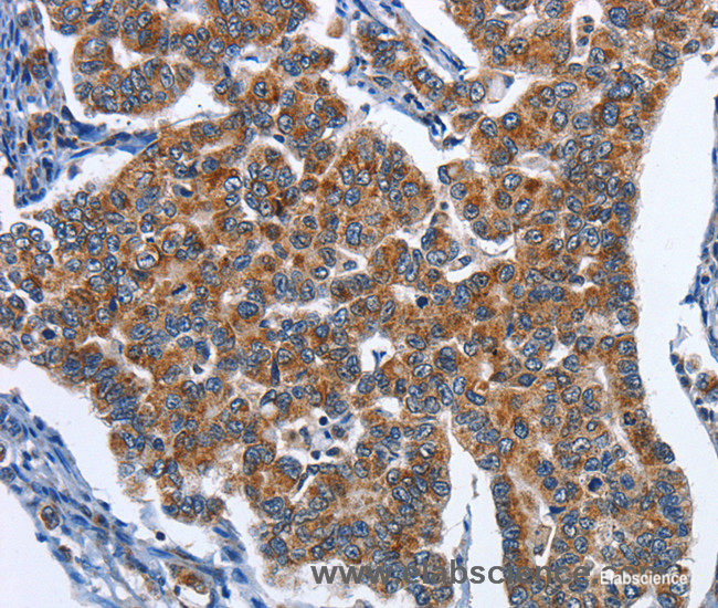 Immunohistochemistry of paraffin-embedded Human breast cancer tissue using CADM3 Polyclonal Antibody at dilution 1:40