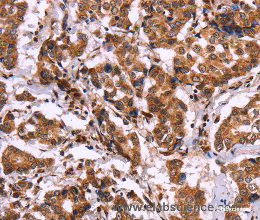 Immunohistochemistry of paraffin-embedded Human breast cancer tissue using CARD11 Polyclonal Antibody at dilution 1:40