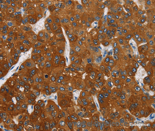 Immunohistochemistry of paraffin-embedded Human liver cancer tissue using CARD9 Polyclonal Antibody at dilution 1:70