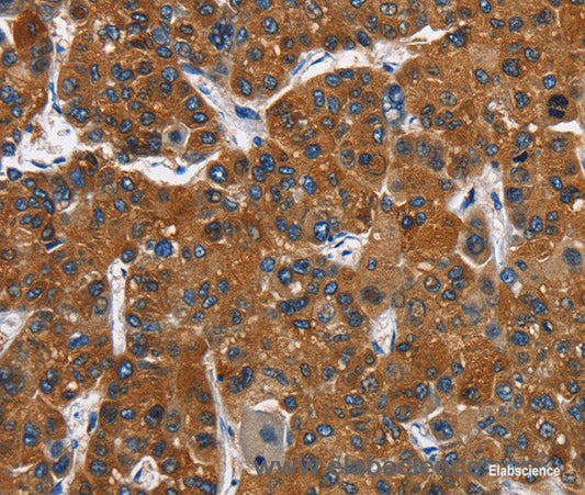 Immunohistochemistry of paraffin-embedded Human liver cancer tissue using CATSPER3 Polyclonal Antibody at dilution 1:60