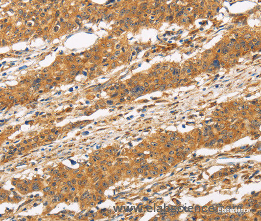 Immunohistochemistry of paraffin-embedded Human gasrtic cancer tissue using CD22 Polyclonal Antibody at dilution 1:50