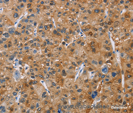 Immunohistochemistry of paraffin-embedded Human liver cancer tissue using NCR3 Polyclonal Antibody at dilution 1:40