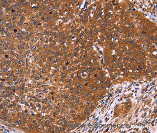 Immunohistochemistry of paraffin-embedded Human cervical cancer tissue using CDC37L1 Polyclonal Antibody at dilution 1:60
