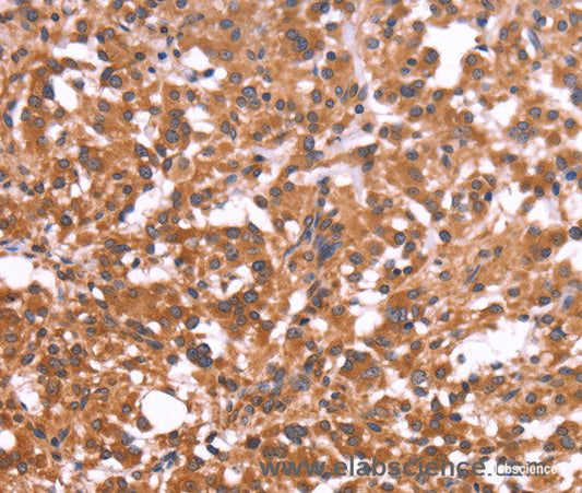Immunohistochemistry of paraffin-embedded Human thyroid cancer tissue using CRISP3 Polyclonal Antibody at dilution 1:50