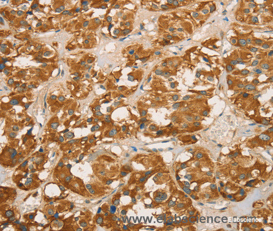 Immunohistochemistry of paraffin-embedded Human thyroid cancer tissue using RBBP8 Polyclonal Antibody at dilution 1:65