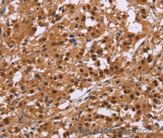 Immunohistochemistry of paraffin-embedded Human thyroid cancer tissue using CTNNBL1 Polyclonal Antibody at dilution 1:50