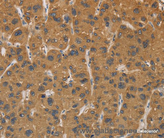 Immunohistochemistry of paraffin-embedded Human liver cancer tissue using CYP17A1 Polyclonal Antibody at dilution 1:30
