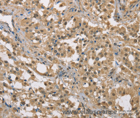 Immunohistochemistry of paraffin-embedded Human thyroid cancer tissue using DACH2 Polyclonal Antibody at dilution 1:40