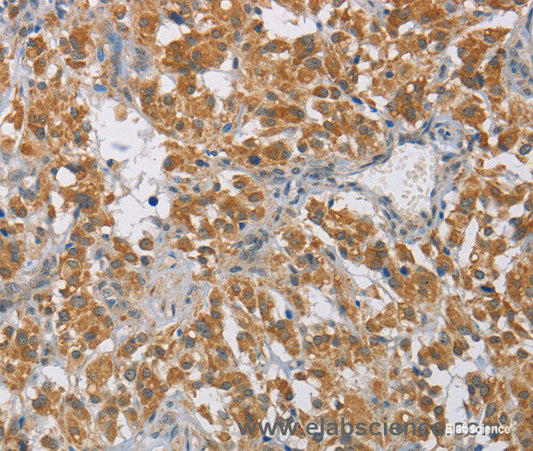 Immunohistochemistry of paraffin-embedded Human thyroid cancer tissue using DIO1 Polyclonal Antibody at dilution 1:60