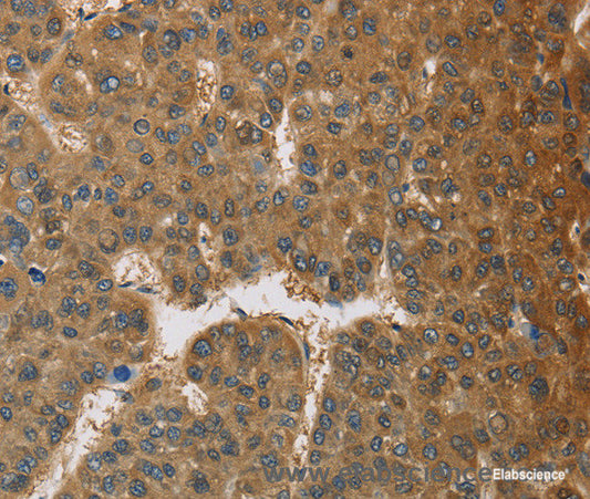 Immunohistochemistry of paraffin-embedded Human liver cancer tissue using TNFRSF10D Polyclonal Antibody at dilution 1:60