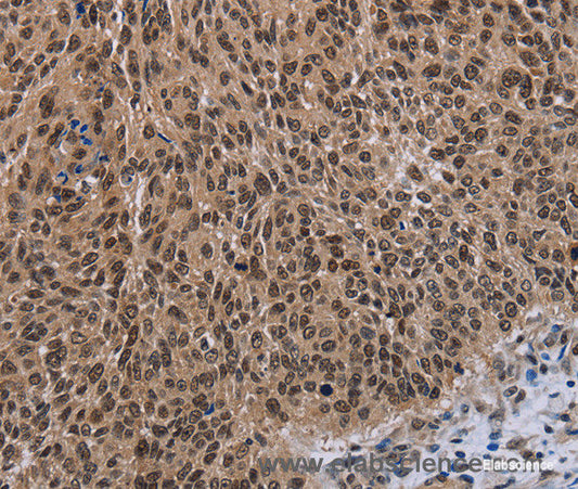 Immunohistochemistry of paraffin-embedded Human lung cancer tissue using DLX4 Polyclonal Antibody at dilution 1:50
