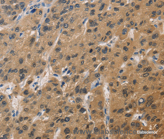 Immunohistochemistry of paraffin-embedded Human liver cancer tissue using DUSP26 Polyclonal Antibody at dilution 1:60