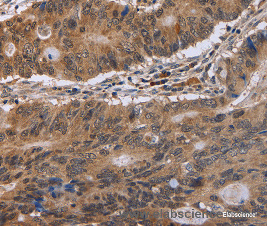 Immunohistochemistry of paraffin-embedded Human colon cancer tissue using EIF3H Polyclonal Antibody at dilution 1:40