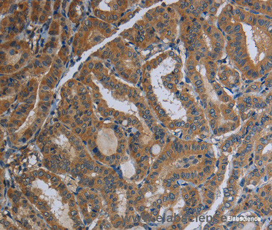 Immunohistochemistry of paraffin-embedded Human thyroid cancer tissue using FAAH Polyclonal Antibody at dilution 1:40