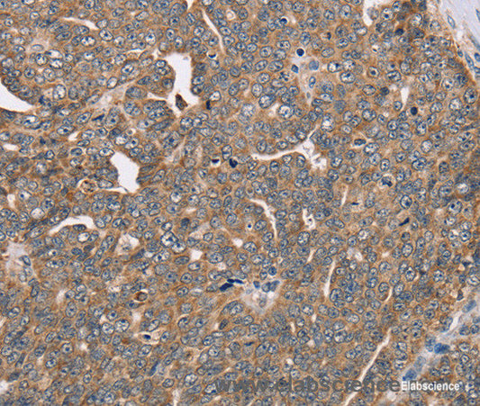 Immunohistochemistry of paraffin-embedded Human cervical cancer tissue using FAIM2 Polyclonal Antibody at dilution 1:40