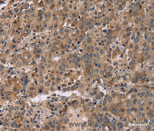 Immunohistochemistry of paraffin-embedded Human liver cancer tissue using FAM107A Polyclonal Antibody at dilution 1:30