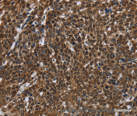 Immunohistochemistry of paraffin-embedded Human cervical cancer tissue using FASTKD2 Polyclonal Antibody at dilution 1:50