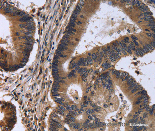 Immunohistochemistry of paraffin-embedded Human colon cancer tissue using FSTL1 Polyclonal Antibody at dilution 1:30