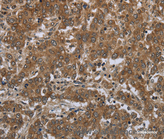 Immunohistochemistry of paraffin-embedded Human liver cancer tissue using GABRB1 Polyclonal Antibody at dilution 1:50
