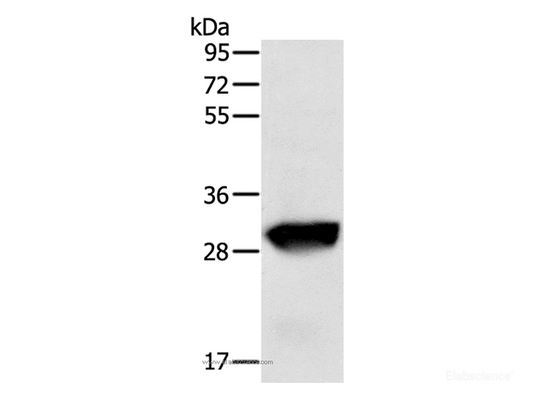 Western Blot analysis of Human liver cancer tissue using GSTO1 Polyclonal Antibody at dilution of 1:200