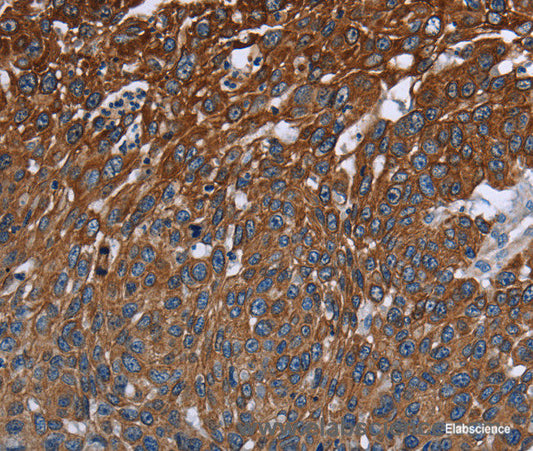 Immunohistochemistry of paraffin-embedded Human lung cancer tissue using FCGR3A Polyclonal Antibody at dilution 1:40