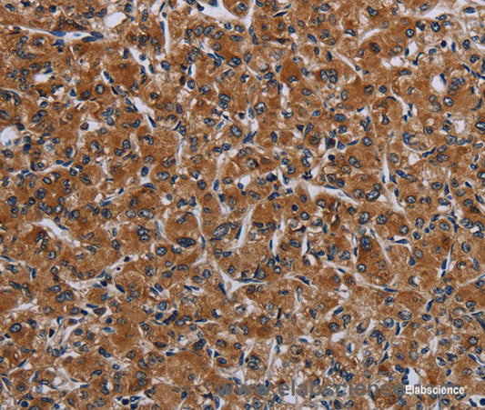 Immunohistochemistry of paraffin-embedded Human prostate cancer tissue using IRGM Polyclonal Antibody at dilution 1:50