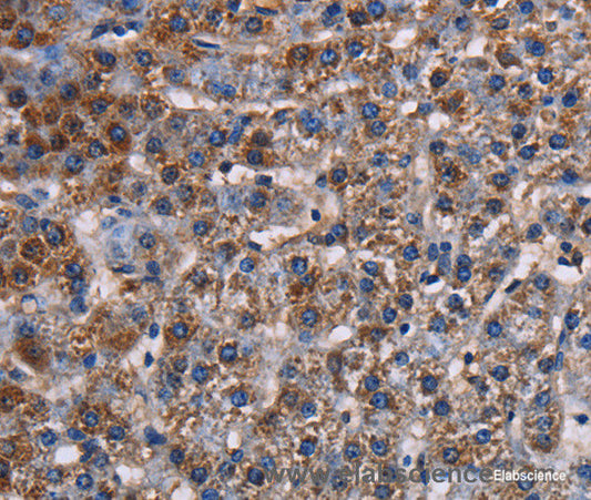 Immunohistochemistry of paraffin-embedded Human lung cancer tissue using KCNK1 Polyclonal Antibody at dilution 1:50