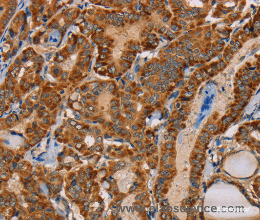 Immunohistochemistry of paraffin-embedded Human thyroid cancer tissue using MBNL3 Polyclonal Antibody at dilution 1:30