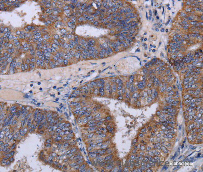 Immunohistochemistry of paraffin-embedded Human colon cancer tissue using MT3 Polyclonal Antibody at dilution 1:50