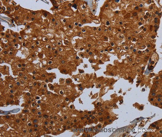 Immunohistochemistry of paraffin-embedded Human prostate cancer tissue using ENTPD7 Polyclonal Antibody at dilution 1:60