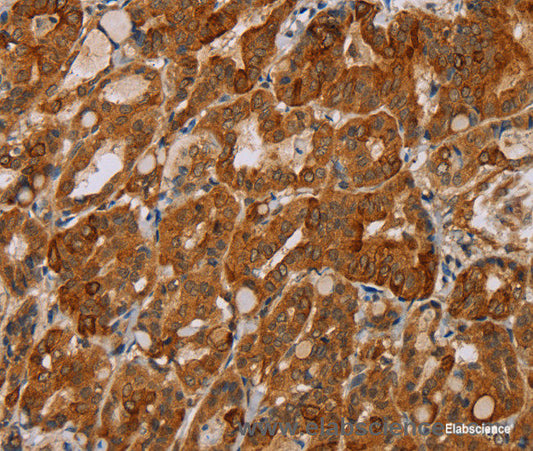 Immunohistochemistry of paraffin-embedded Human thyroid cancer tissue using MTUS1 Polyclonal Antibody at dilution 1:40