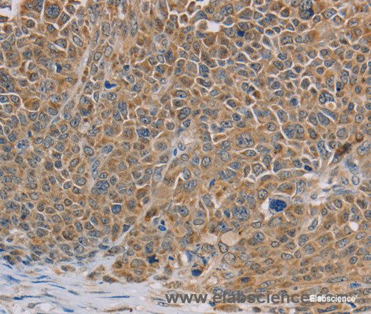 Immunohistochemistry of paraffin-embedded Human ovarian cancer tissue using NDUFS7 Polyclonal Antibody at dilution 1:40