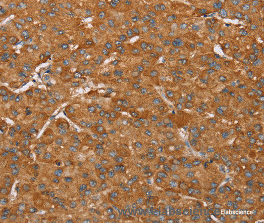Immunohistochemistry of paraffin-embedded Human liver cancer tissue using PAGE5 Polyclonal Antibody at dilution 1:55