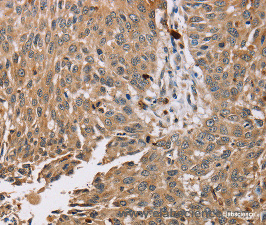 Immunohistochemistry of paraffin-embedded Human lung cancer tissue using PDLIM7 Polyclonal Antibody at dilution 1:35