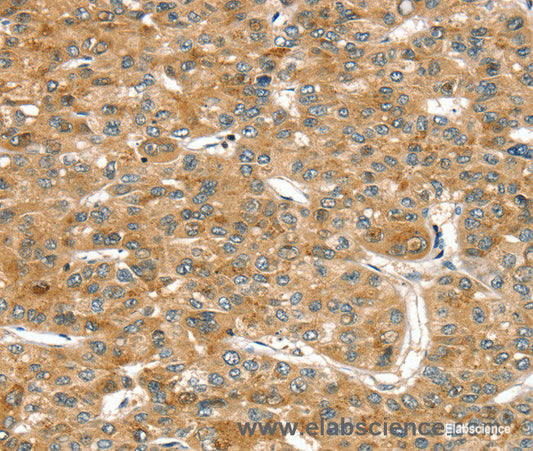 Immunohistochemistry of paraffin-embedded Human liver cancer tissue using RASSF9 Polyclonal Antibody at dilution 1:45