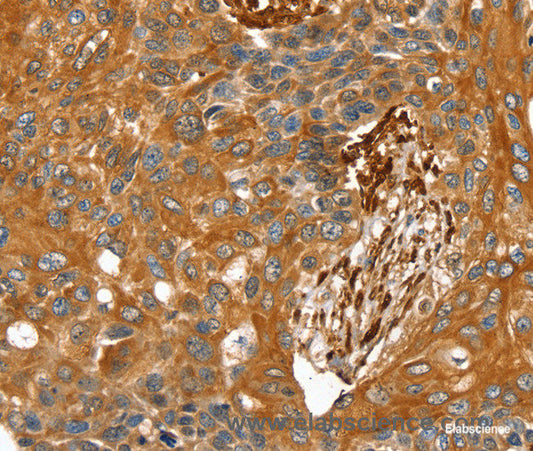 Immunohistochemistry of paraffin-embedded Human esophagus cancer tissue using TAGLN Polyclonal Antibody at dilution 1:30