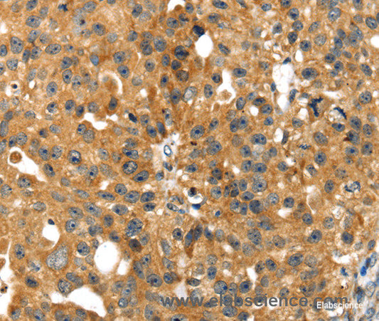 Immunohistochemistry of paraffin-embedded Human breast cancer tissue using SMYD4 Polyclonal Antibody at dilution 1:40