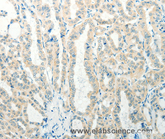 Immunohistochemistry of paraffin-embedded Human thyroid cancer tissue using RAB25 Polyclonal Antibody at dilution 1:50