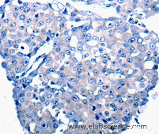 Immunohistochemistry of paraffin-embedded Human breast cancer tissue using CCL2 Polyclonal Antibody at dilution 1:50