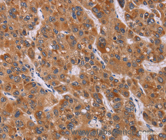Immunohistochemistry of paraffin-embedded Human liver cancer tissue using CALCA Polyclonal Antibody at dilution 1:40