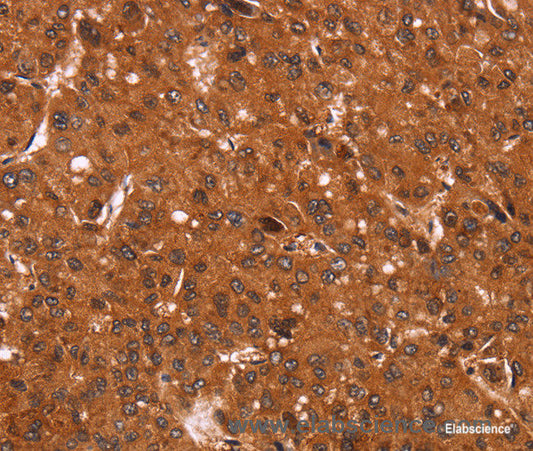 Immunohistochemistry of paraffin-embedded Human liver cancer tissue using Cyclin D3 Polyclonal Antibody at dilution 1:40