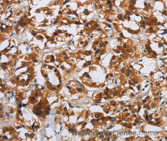 Immunohistochemistry of paraffin-embedded Human thyroid cancer tissue using DSP Polyclonal Antibody at dilution 1:40