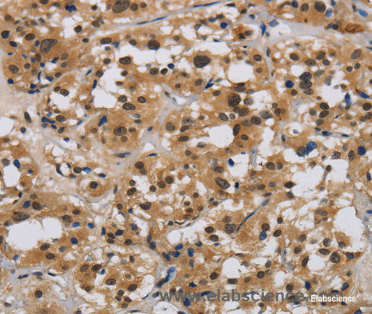 Immunohistochemistry of paraffin-embedded Human thyroid cancer tissue using E2F4 Polyclonal Antibody at dilution 1:40