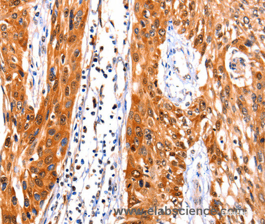 Immunohistochemistry of paraffin-embedded Human esophagus cancer tissue using FBLN1 Polyclonal Antibody at dilution 1:47