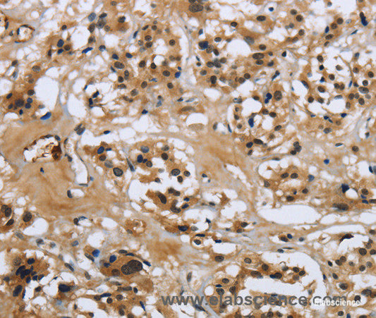 Immunohistochemistry of paraffin-embedded Human thyroid cancer tissue using LGALS7 Polyclonal Antibody at dilution 1:50